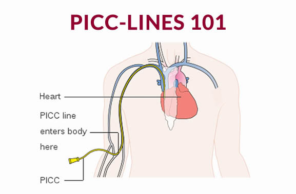 PICC LINE DIAGRAM – Marica Capriotti